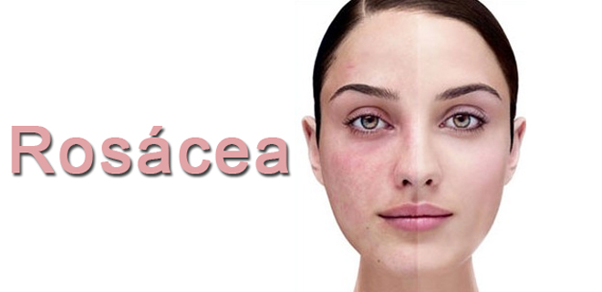 Rosacea-Ltd IV for Ocular and Facial Rosacea